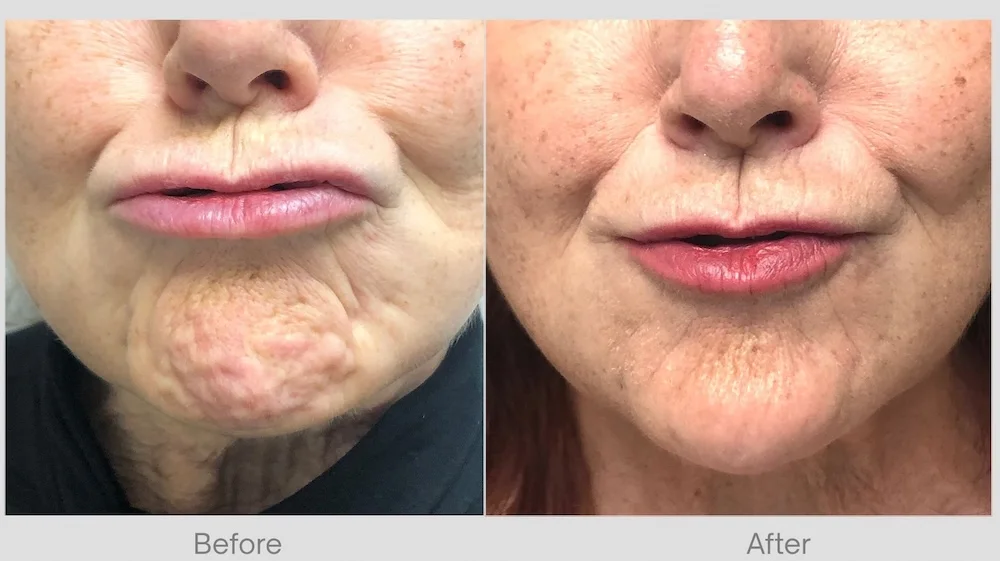 Chin Dimples Before & After