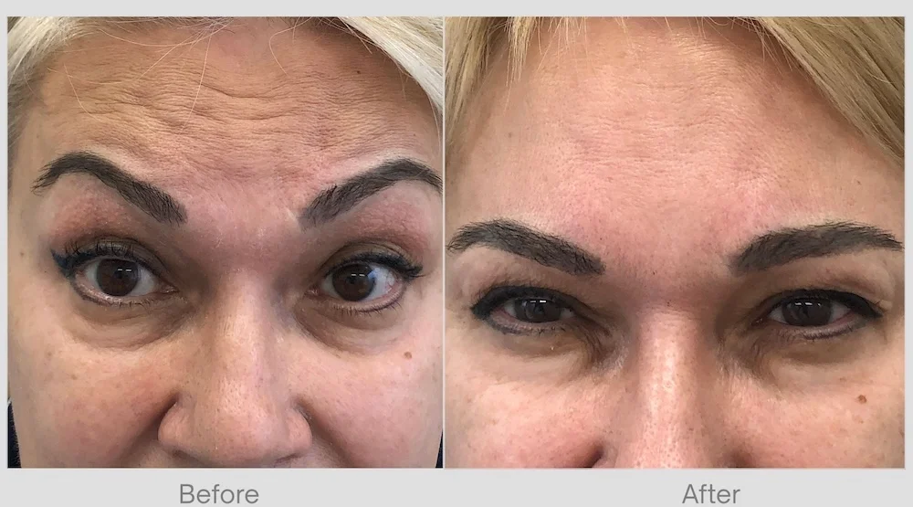 Forehead- Glabellar lines Before & After 