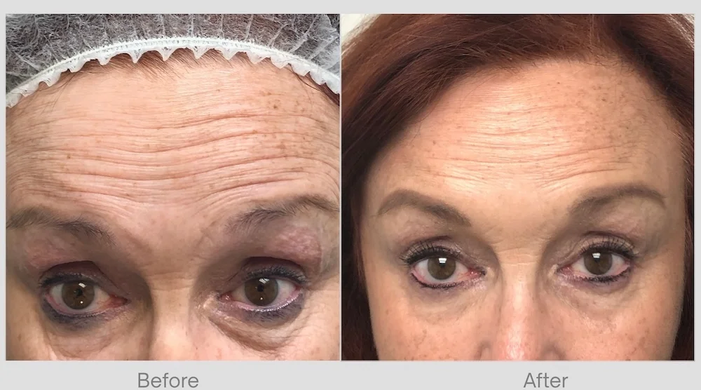 Before & After Results