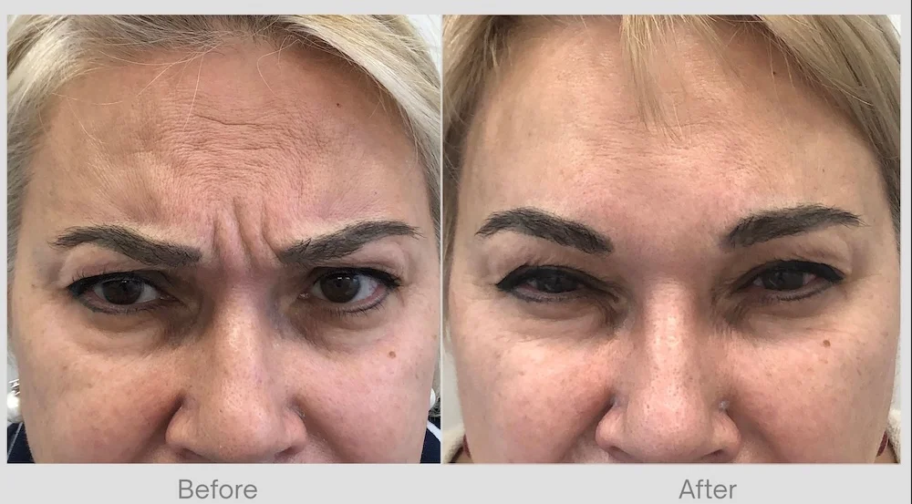 Mature Frown Lines Before & After 