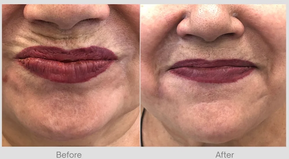 Lip Lines Before & After 