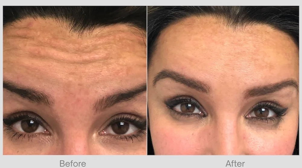 Deep Forehead Lines Before & After 