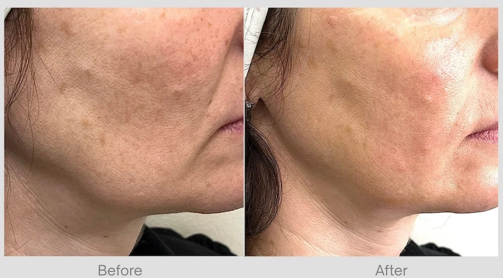 Dermal Fillers Before & After for Jawline Definition