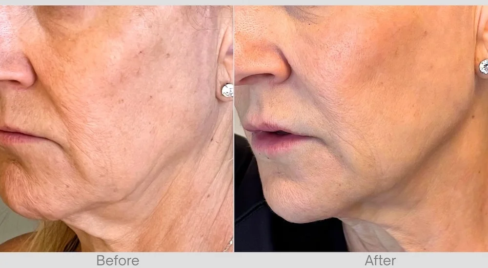 Dermal Fillers Before & After for Mature Face