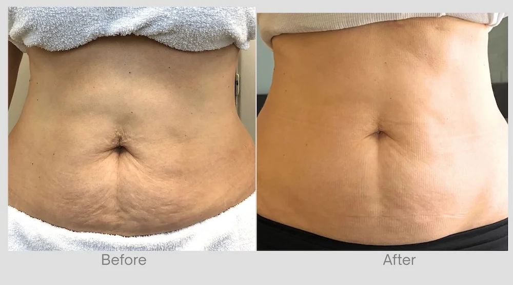 Improved abdominal skin firmness and smoother-looking body contour after treatment.