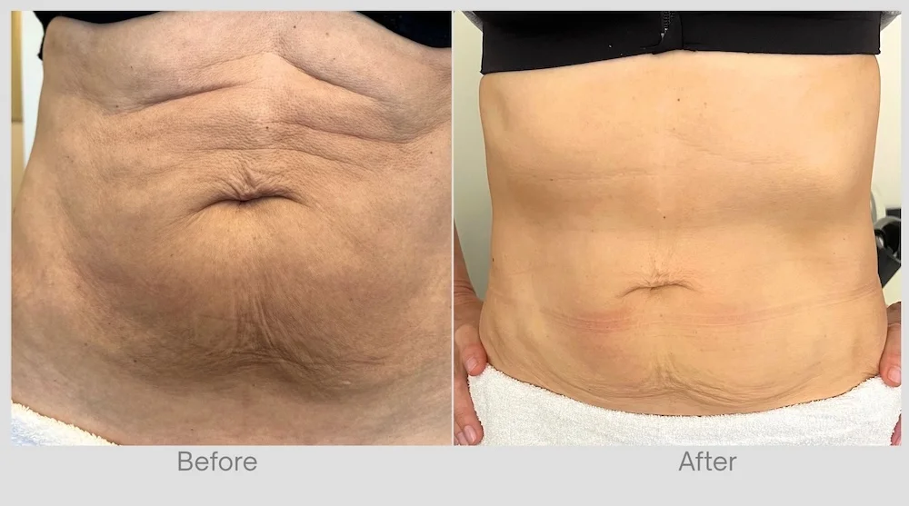 Endospheres abdominal skin tightening before and after