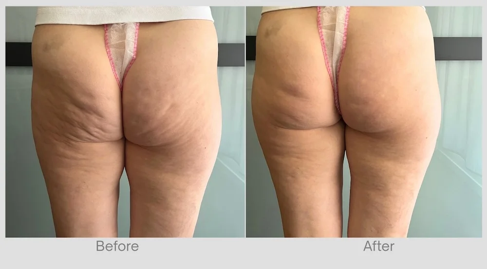 Endospheres Therapy Before & After for Thighs