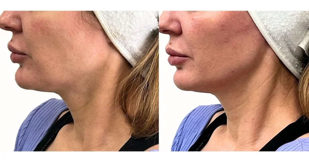 Dermal filler before and after result at MedVSPA Toronto