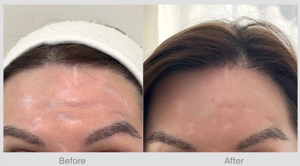 RF Microneedling Before & After for Acne Scars