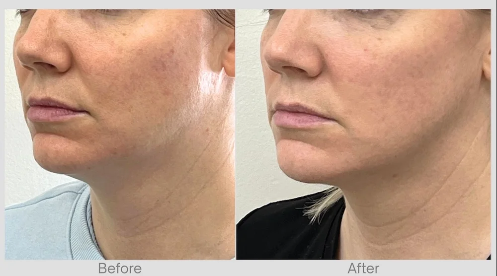 Better jawline definition and firmer skin after RF microneedling.