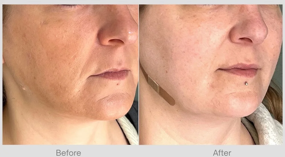 Improvement in pores, texture, dark spots after RF microneedling