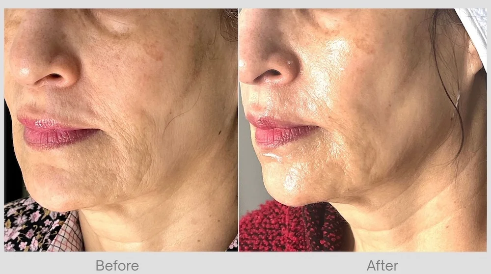 SkinVive before and after showing improvement in chicks and under eyes skin quality