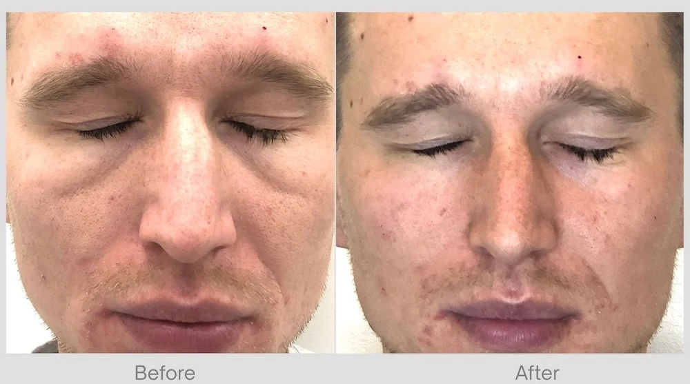 Under-Eye Filler Before & After