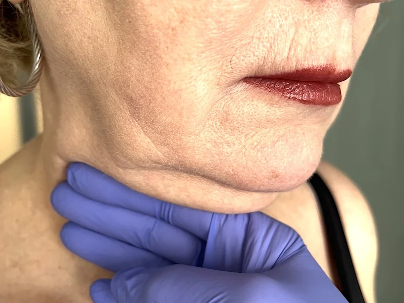 Botox and Juvéderm treatment planning for a mature face