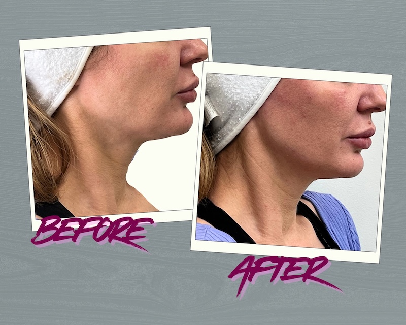 Mture skin after filler injections before and after jawline and chin improvement