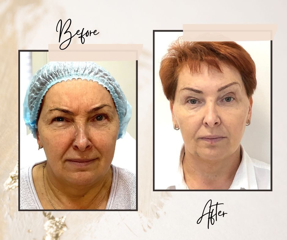 Dermal Fillers for Women Over 45: Natural Anti-Aging Solutions in Toronto