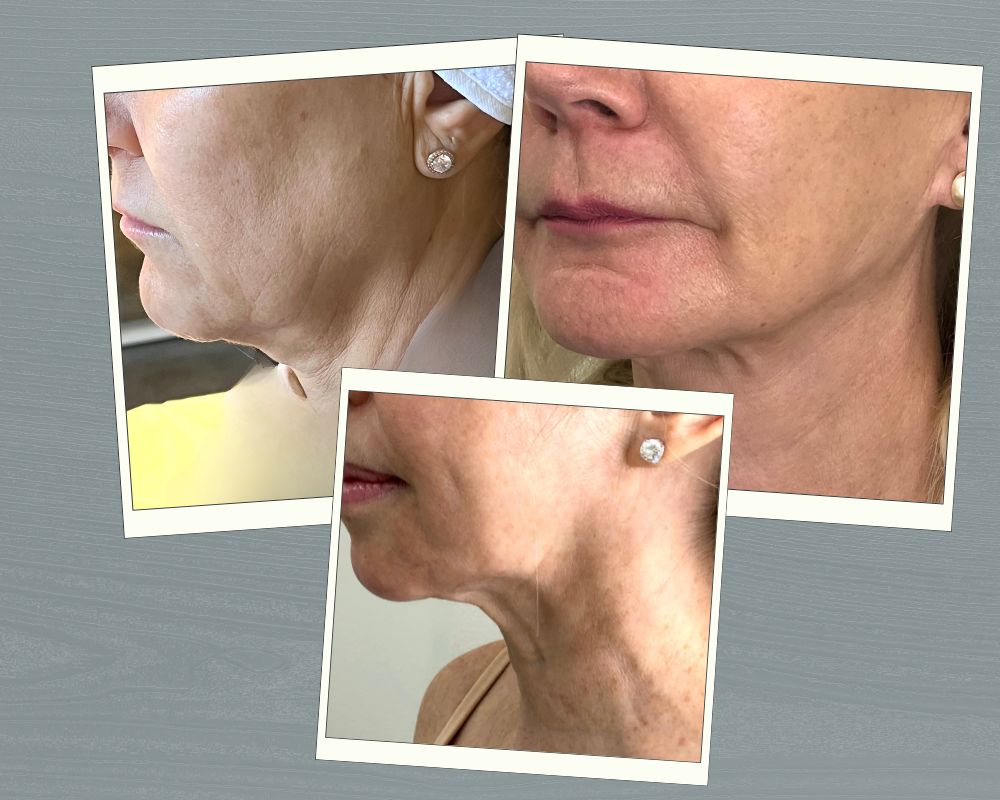 Jawline losing definition due to aging, muscle tension, and menopause-related changes – MedVSPA Toronto