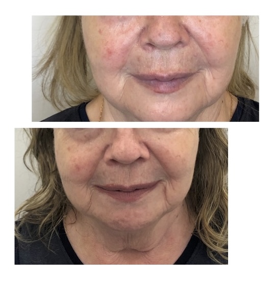 Precision jawline filler using Juvederm Volux to rebuild structure and contour – MedVSPA Toronto.