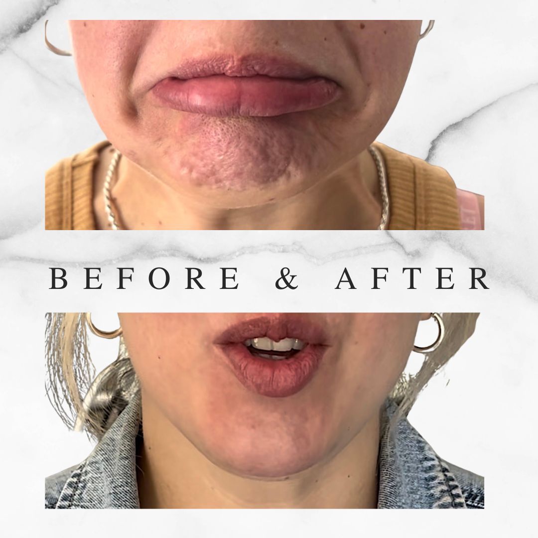 Chin Botox Before and After Results Botox before and after chin dimpling smoothing, Toronto client