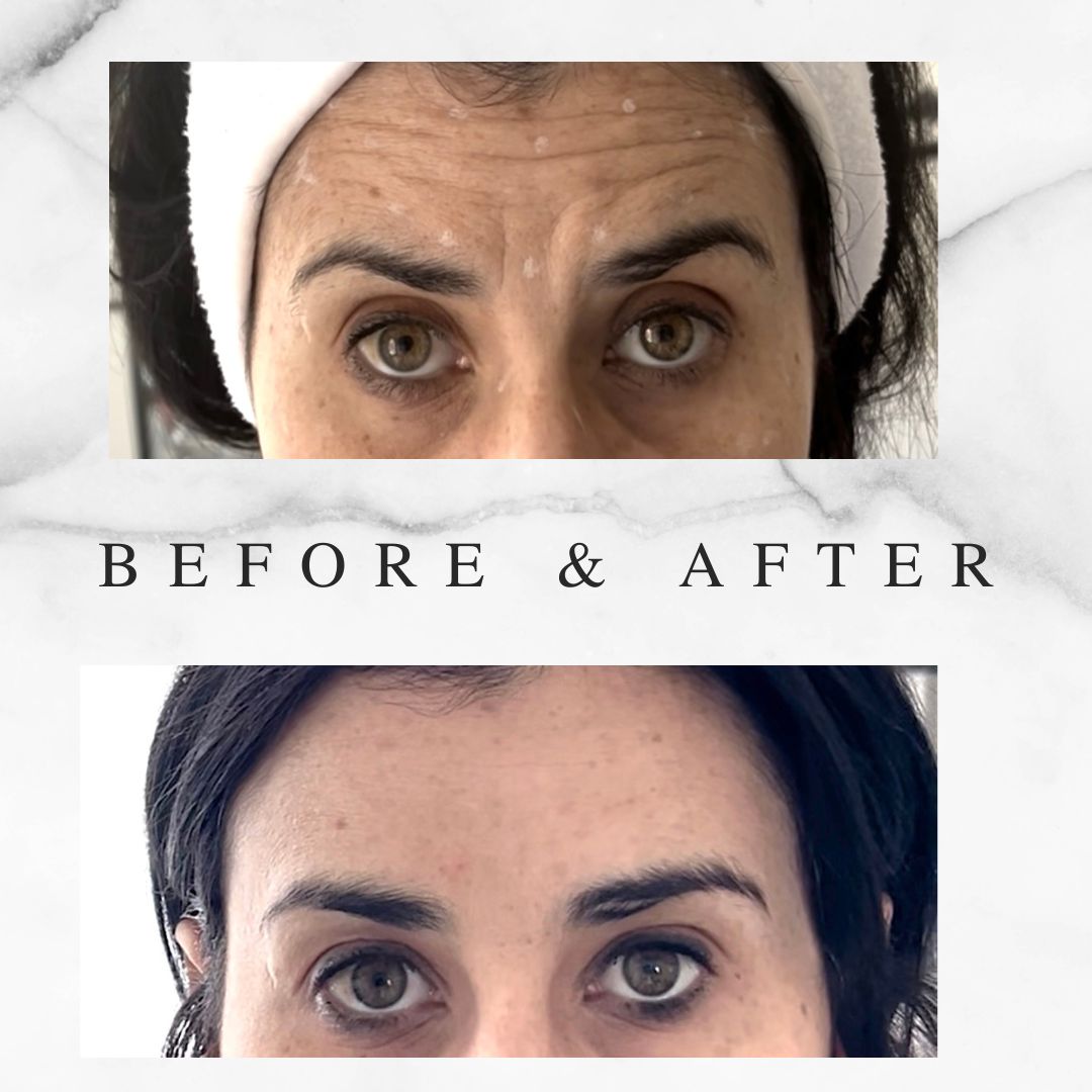 Botox Forehead Results Before & After Before and after Botox on forehead wrinkles, Toronto client results