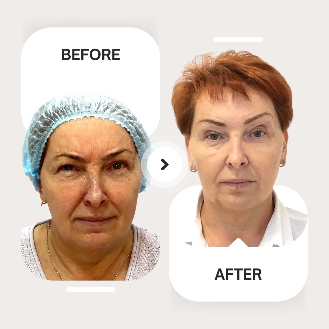 Skinvive and Botox result for mature client Before and after results of Skinvive and Botox treatment