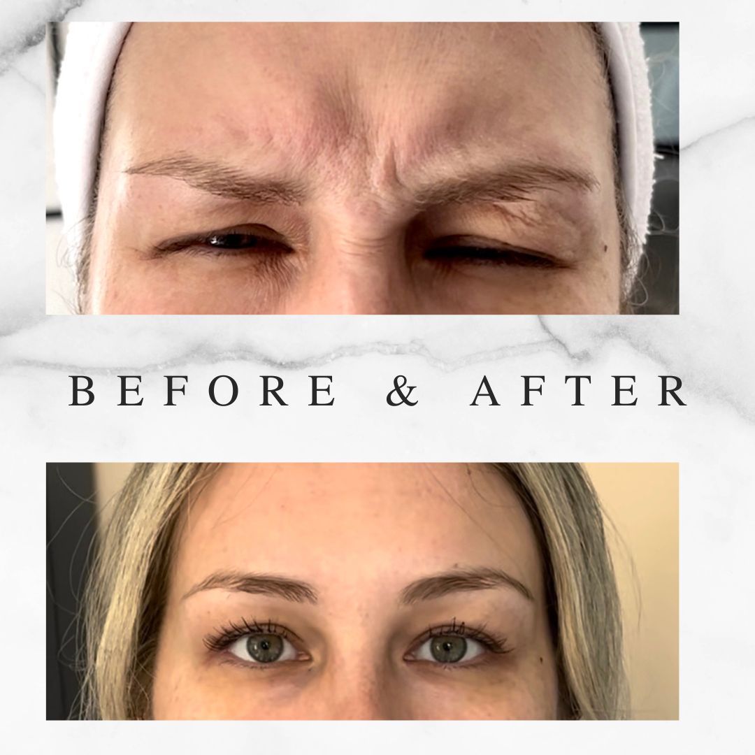Hooded Eyelids Botox Results Toronto Botox before and after hooded eyelids treatment in Toronto