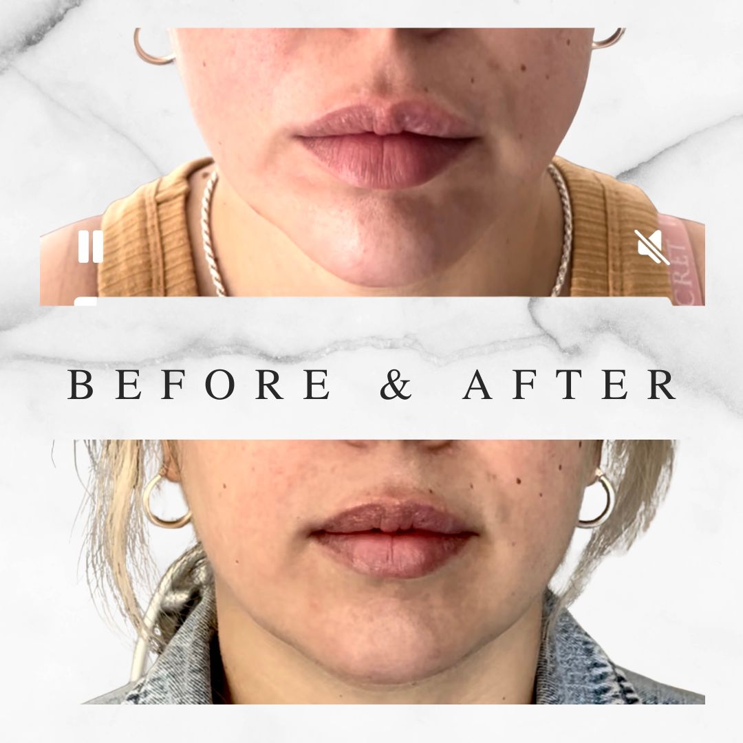 Botox Jawline Slimming Before & After Before and after Botox jawline slimming results in Toronto