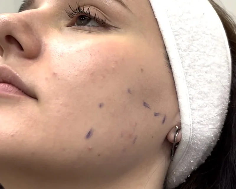 Assessment of the masseter muscle before Masseter Botox treatment in Toronto