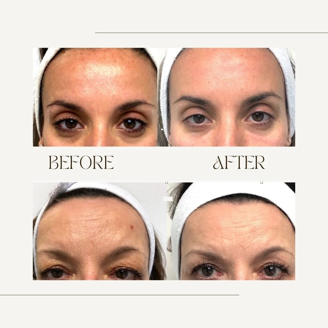 Botox forehead before and after for mature patients in Toronto