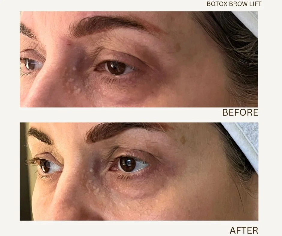 Before and after Botox brow lift results at MedVSPA
