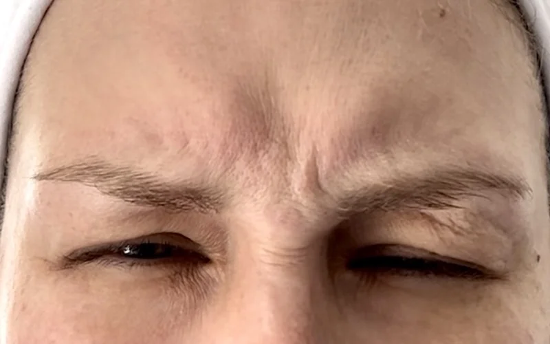 Dynamic facial assessment before a Botox brow lift