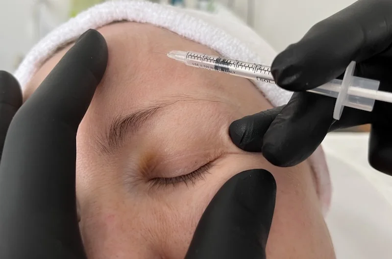 Botox brow lift injection performed at MedVSPA in Toronto
