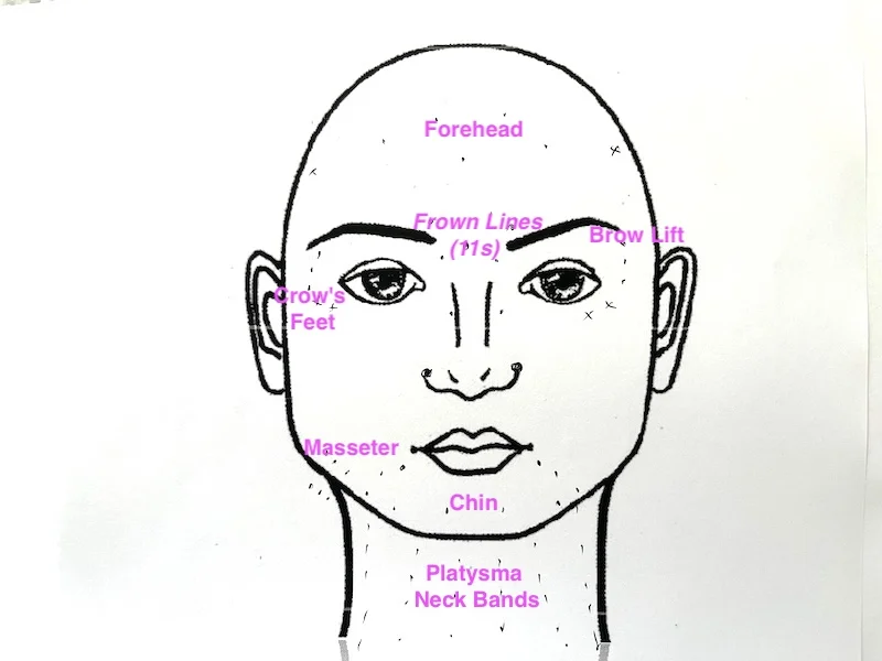 Diagram showing common Botox treatment areas including the forehead, frown lines, crow's feet, brow lift, chin, masseter, and neck bands.