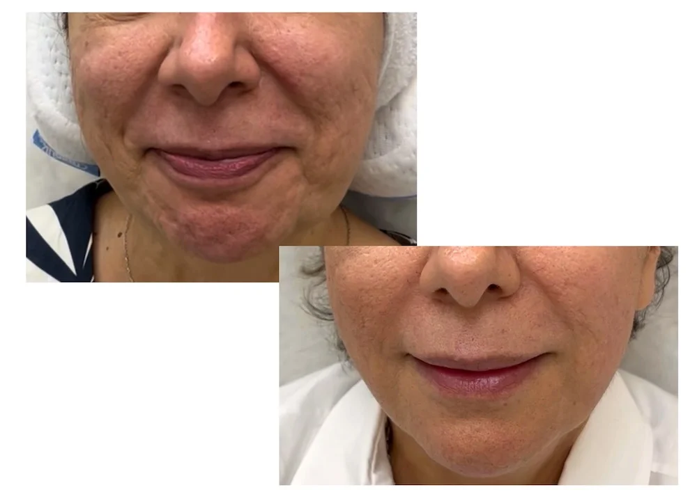 Before and after Chin Botox treatment for chin dimpling and lower face balance at MedVSPA Toronto