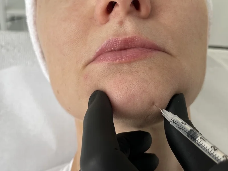 Chin Botox injection performed by Mariina Vashkevich RN at MedVSPA Toronto