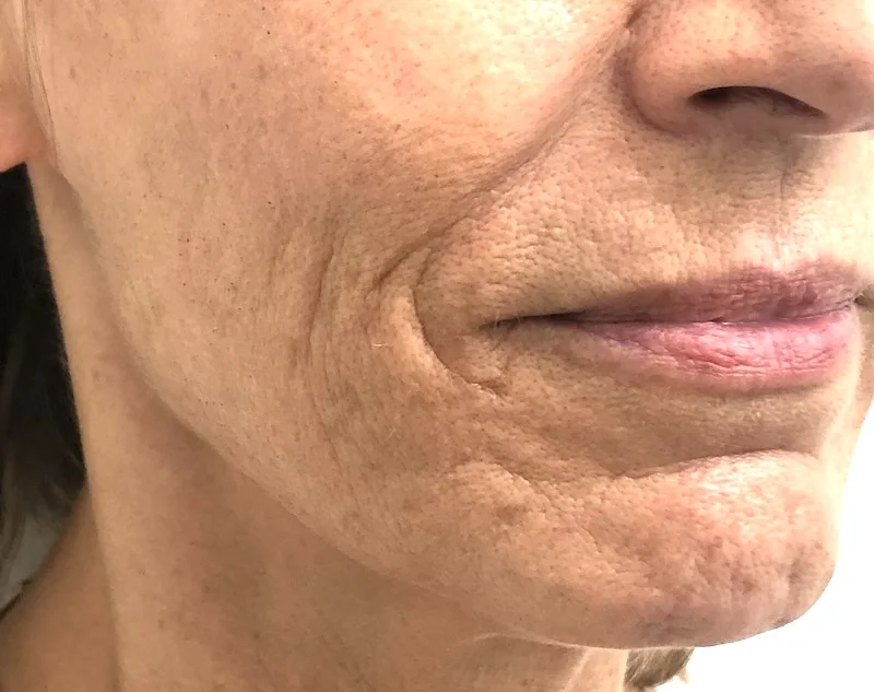 Consultation for Chin Botox in a mature patient to assess lower face muscle balance