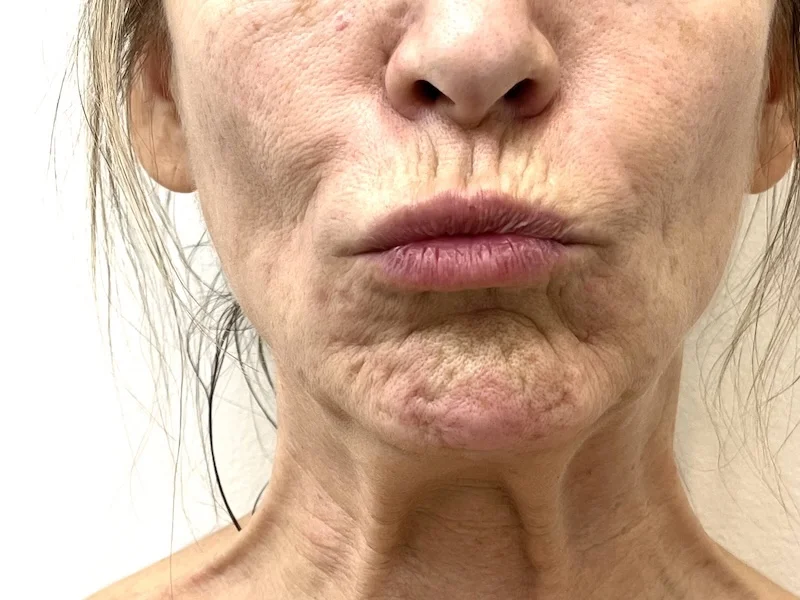Mature client showing chin dimpling and mentalis muscle overactivity before Chin Botox treatment