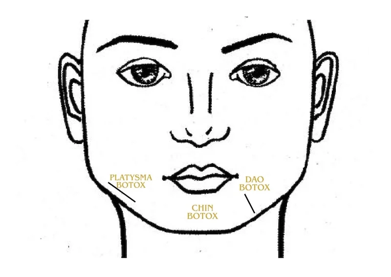 Chin Botox treatment diagram showing the mentalis muscle and related lower face muscles