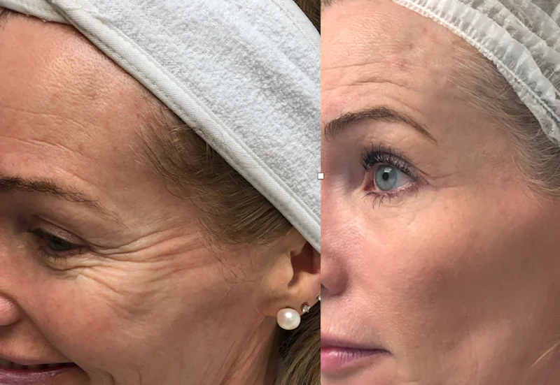 Before and after Crow's Feet Botox showing softer eye wrinkles and natural-looking results
