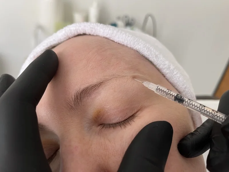 Botox injection into the crow's feet area around the eyes at MedVSPA Toronto