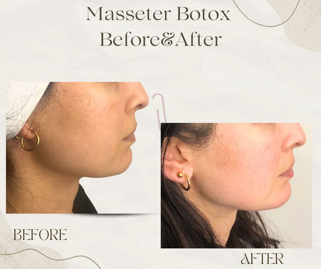 Before and after Masseter Botox for jawline slimming in Toronto