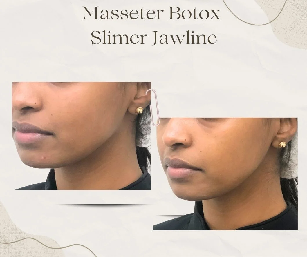 Assessment of the masseter muscle before Masseter Botox treatment in Toronto