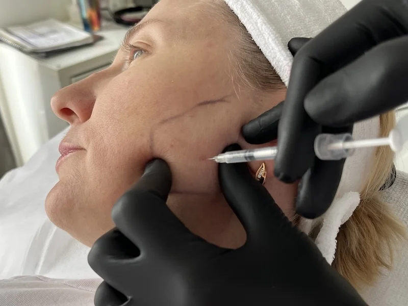 Botox injection into the masseter muscle during treatment in Toronto