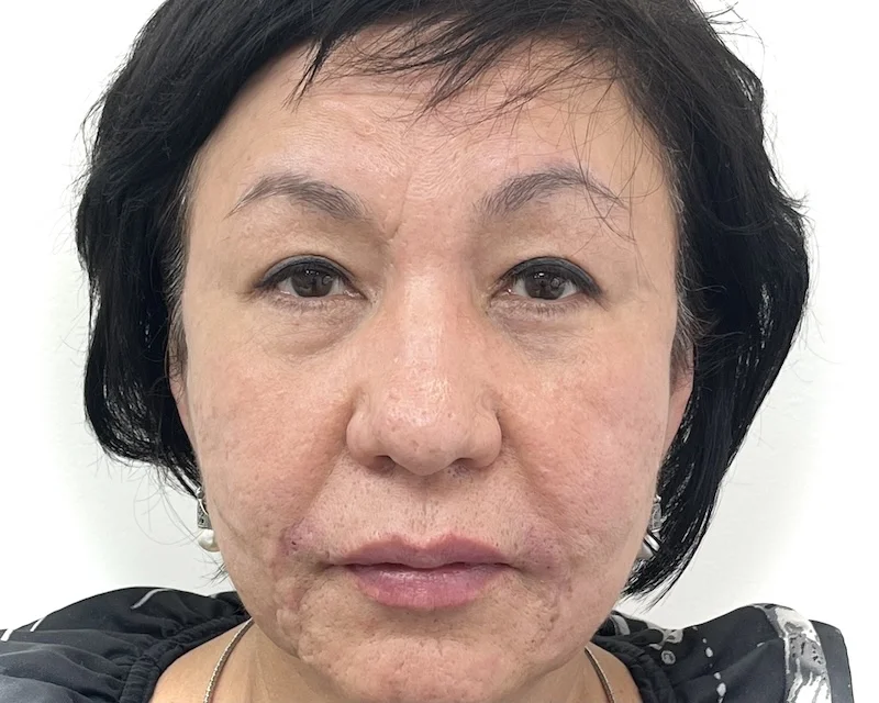 Personalized Botox treatment for mature faces in Toronto