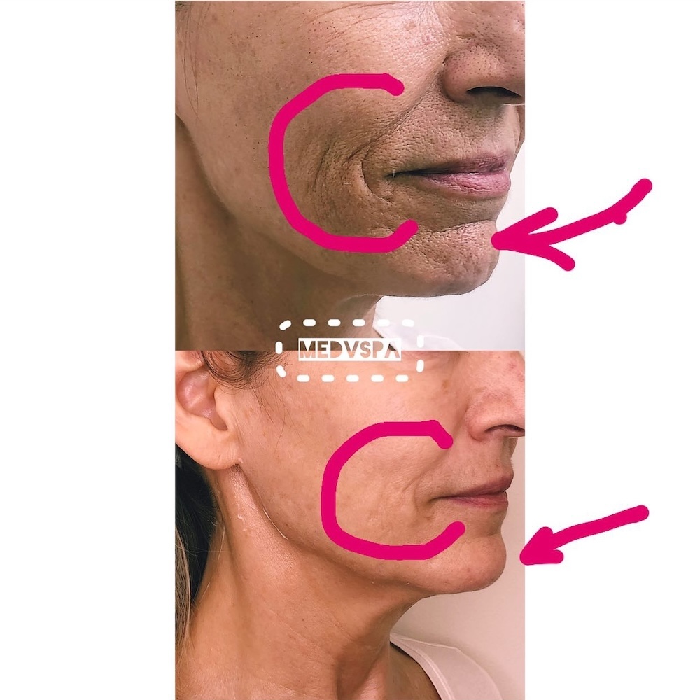 Mature client with smoother chin, marionette lines and jawline after Botox
