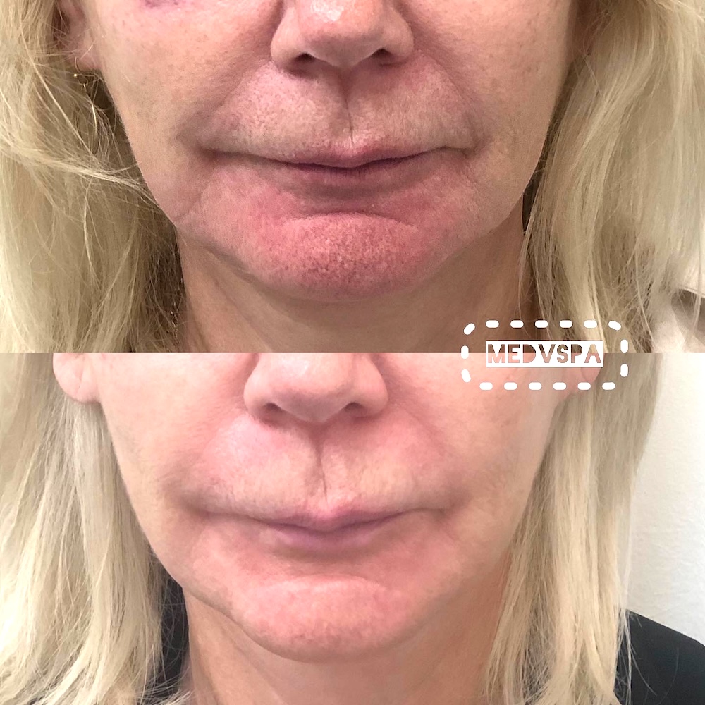 Chin Botox before and after results for menopausal client 