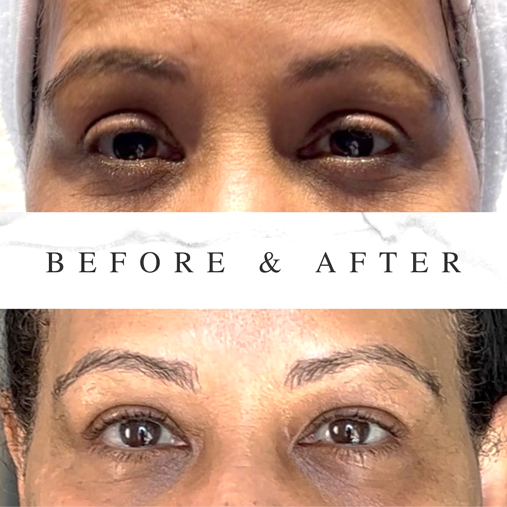 Before and after photos of crow’s feet Botox showing smoother eye wrinkles