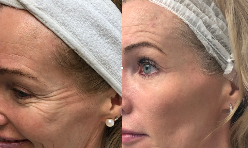 Close-up of mature woman’s eye area before and after Botox treatment