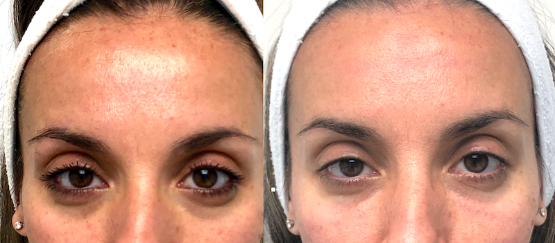 Woman showing natural, refreshed results after Botox for crow’s feet