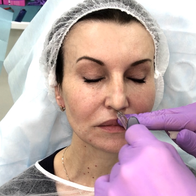 Botox for RN injector Toronto Botox injections for RN injector in Toronto